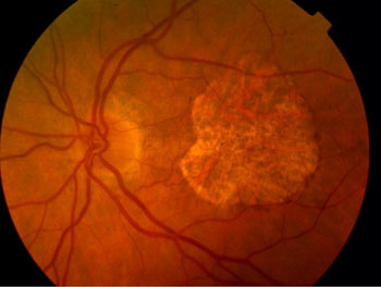 Do you know someone affected by Macular Degeneration - AMD? Image