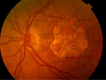 03-amd-rpe-atrophy-and-haem